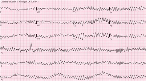 Ventricular Fibrillation ECG (Example 1) | Learn the Heart