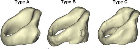 Figure 3 from The role of the cricothyroid joint anatomy in ...