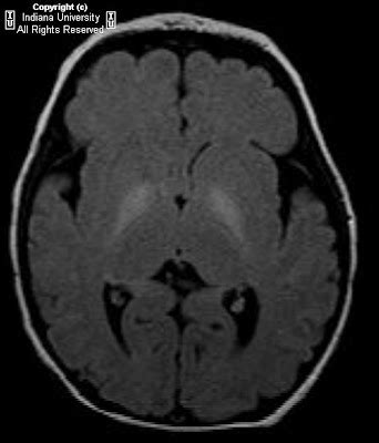 Neuroradiology On the Net: Kernicterus