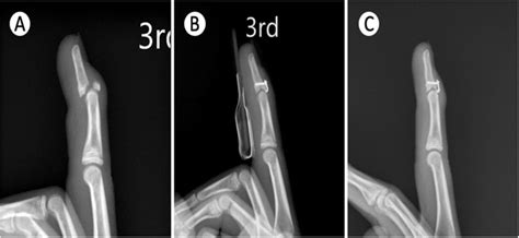 Union of mallet fracture. a The pre-operative radiograph showed mallet ...