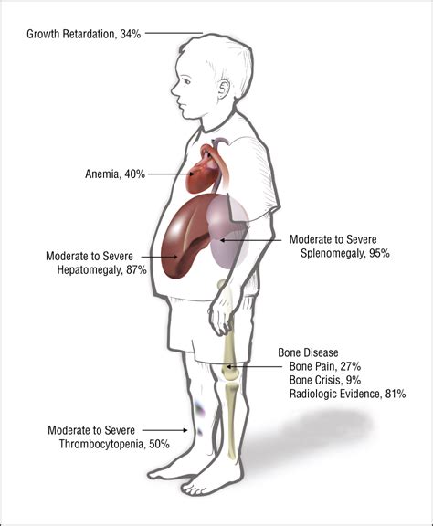 The Clinical and Demographic Characteristics of Nonneuronopathic ...