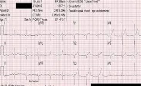 Understanding Septal Infarct: Causes, Symptoms, and Treatment | HintGuru