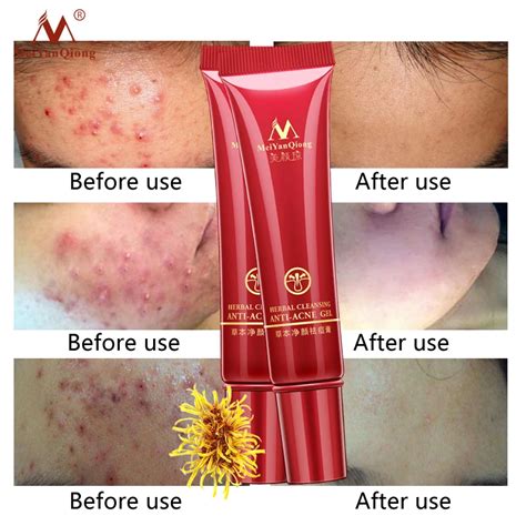 2PCS Skin Care Acne Cleaning Cream Remove Repair Comedone Pimple Acne ...