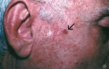 Squamous Cell Carcinoma | Advanced Dermatology Care | Los Alamitos, CA