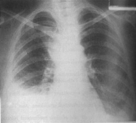 Superior Vena Cava Syndrome: Clinical Features, Diagnosis, and Treatment | Thoracic Key