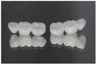 Porcelain Bridges Panorama City | Dental Bridges