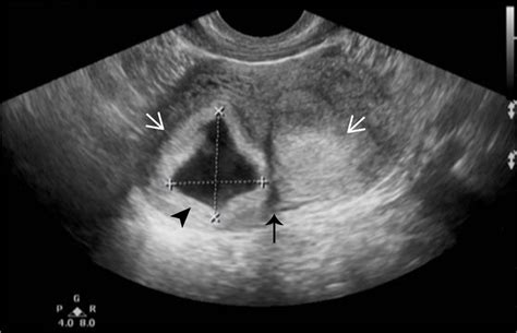 Two-dimensional ultrasound images during the first trimester. A uterine ...