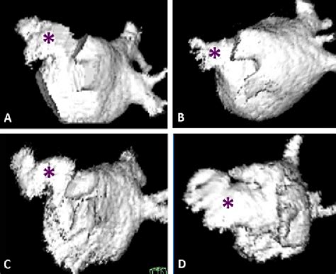 Representative left atrial appendage morphologies (three-dimensional... | Download Scientific ...