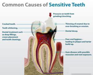 The Common Causes of Teeth Sensitivity. - Platinum Dental Surgery