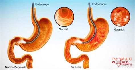 Pin on gastritis recipes and info