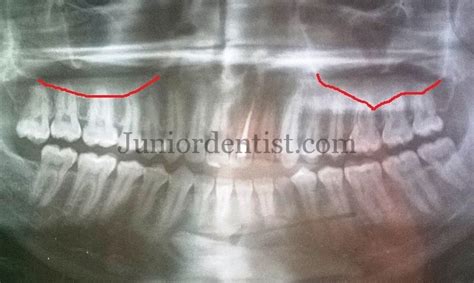 Can Tooth infection cause Sinus infection