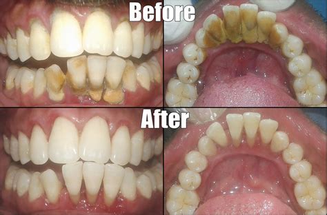 Deep Teeth Cleaning Before And After - TeethWalls