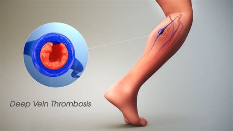 Deep Vein Thrombosis (DVT): Symptoms, Causes, and Treatment
