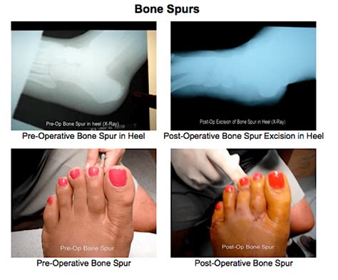 Bone Spur Pictures