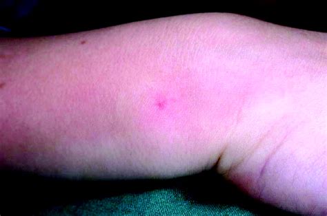 The significance of cutaneous spider naevi in children | Archives of Disease in Childhood