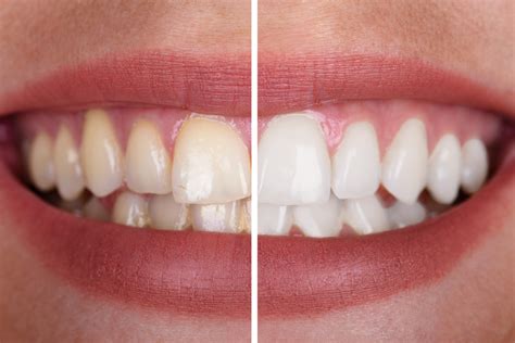 Know More About Pola Teeth Whitening | Dental Blog