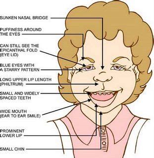 Williams Syndrome - Clip Art Library