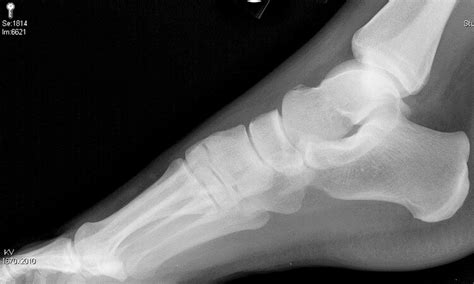 Foot pain after ankle twist — NUEM Blog