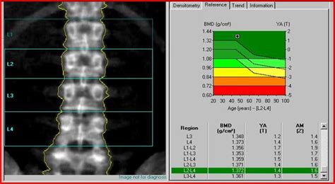 Osteoporosis 2 | Centro Ginecologico Escalante