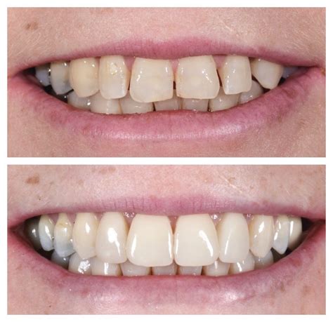 A Complete Guide To Dental Veneers - Docklands Dental