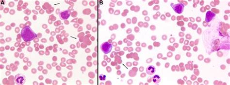 Relapsed lymphoma preceded by cold agglutinin disease | Blood | American Society of Hematology