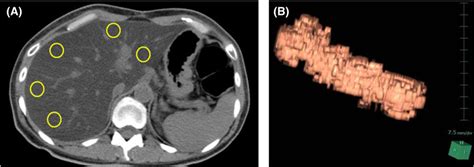 Liver attenuation values were measured on unenhanced computed... | Download Scientific Diagram