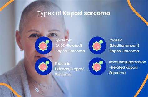 Kaposi Sarcoma: Everything You Need To Know | ACTC