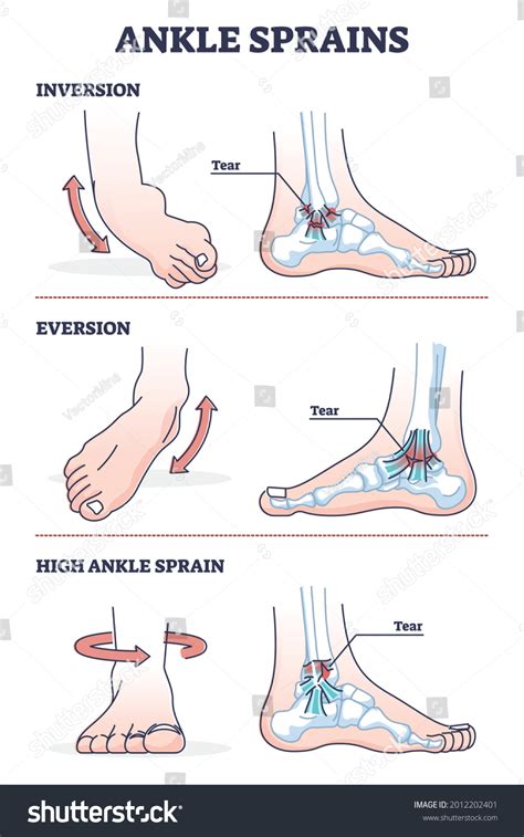 Ankle Sprains Situations Inversion Eversion Injury Stock Vector ...