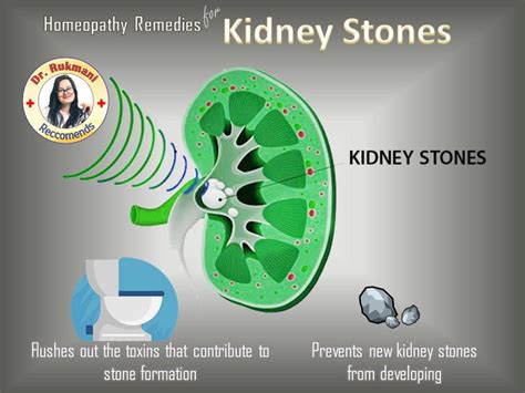 Homeopathy Kidney Stone Treatment Kits - Doctor Recommended | HomeoMart – Homeomart