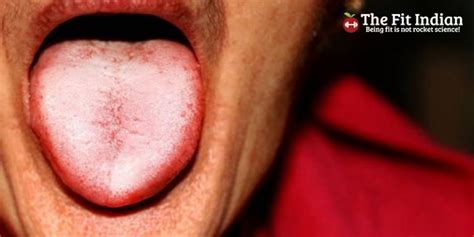 Dangers of Tongue Discoloration - Diseases Associated with Tongue Color ...