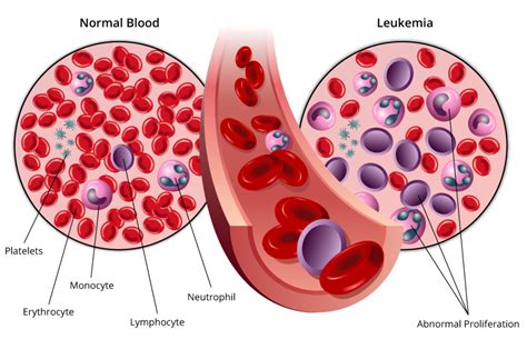 Leukemia - West Cancer Center