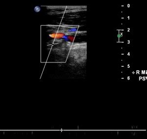 ICA occlusion ultrasound - Angiologist