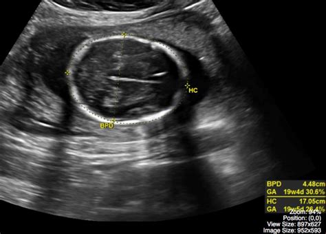 Normal Pregnancy – Undergraduate Diagnostic Imaging Fundamentals