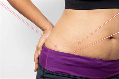 Do Laser Treatments for Weight Loss Work for Fat Loss?