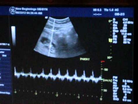 Baby 11 week ultrasound with heartbeat! - YouTube