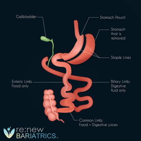 Gastric Bypass vs. Duodenal Switch: Which is Best? Expected Weight-Loss?