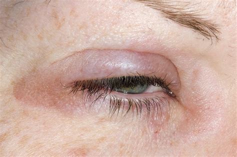 Eyelid swelling due to allergy - Stock Image - C002/9646 - Science Photo Library