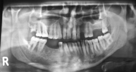 Preoperative orthopantomogram | Download Scientific Diagram
