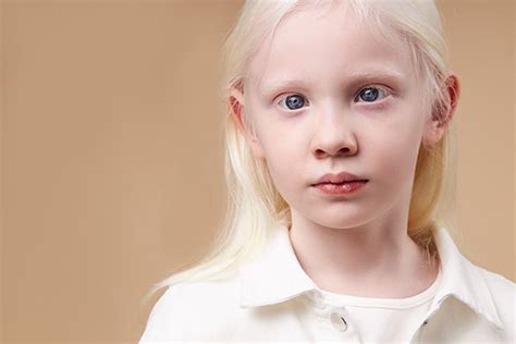 Symptoms, Causes, and Treatment of Albinism | MFine