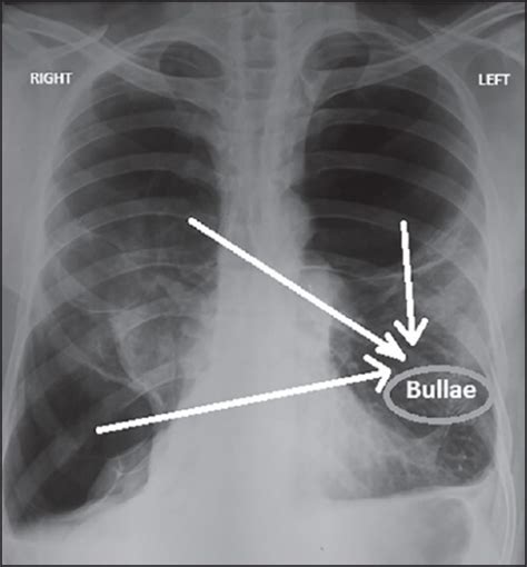 Preoperative chest X-ray showing bullae in right upper | Open-i