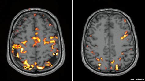 How lack of sleep affects the brain - BBC News