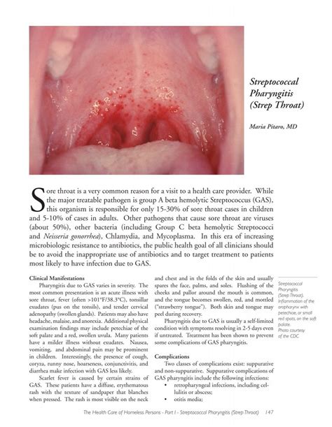 Chlamydia Throat Treatment