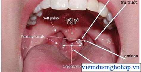 Hình ảnh viêm họng hạt - cách nhận diện từng loại