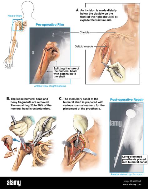 Total Shoulder Joint Replacement Surgery Arthroplasty Stock Photo ...