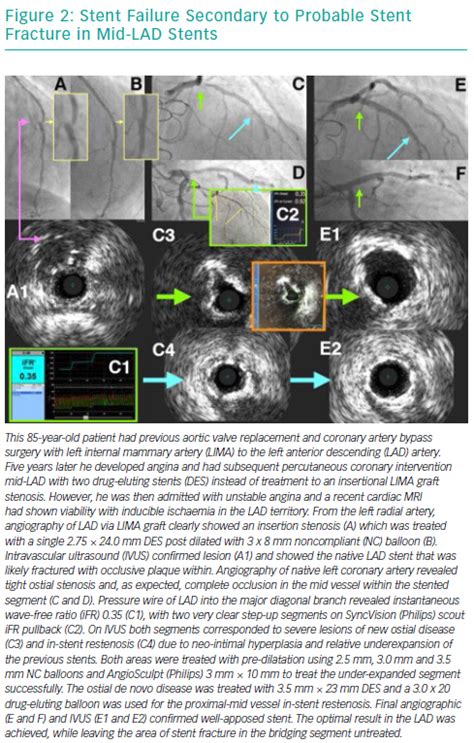 Stent Failure Secondary to Probable Stent Fracture in Mid-LAD Stents ...