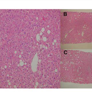 FIGURE E Percutaneous liver biopsies. (A) Cholestatic hepatitis with ...