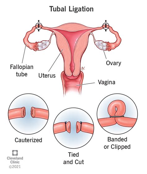 Tubal Ligation: Procedure, Recovery & Side Effects