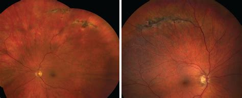 Atrophic Retinal Hole