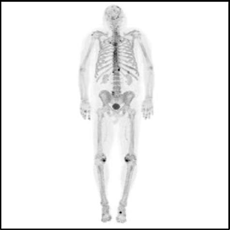 Figure 1 from Early hyperostosis frontalis interna found incidentally ...