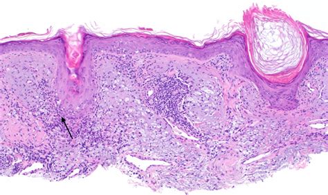 Cureus | Histiocyte-rich Discoid Lupus Erythematosus: A Peculiar Perifollicular Distribution ...